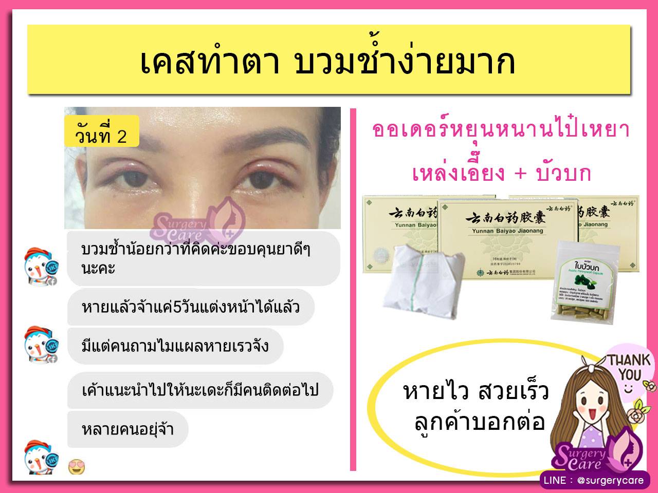รีวิวทำตา,แก้ตา,ทำตา,ตา2ชั้น,รีวิวศัลยกรรมตา2ชั้น,รีวิวผ่าตา,รีวิวทำตา,รีวิวทำตาสองชั้น,รีวิวลดบวมช้ำ รีวิวศัลยกรรม,รีวิว, ศัลยกรรม, หยุนหนานไป๋เหยา, Yunnanpaiyao, เหล่งเอี้ยง, เหล่งเอี้ยงextra, surgerycare, review, รีวิวผ่าตัด