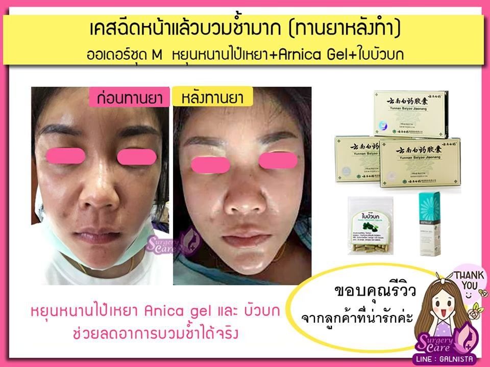 รีวิวฉีดหน้า,บวมช้ำน้อย,เหล่งเอี้ยง,เหล่งเอี้ยงextra ,สมุนไพรจีน,ยาลดบวมช้ำศัลยกรรม, ลดปวด, ลดอักเสบ, สมานแผล, ทำศัยกรรมอยากหายไว, เหล่งเอี้ยงของแท้, เหล่งเอี้ยง, เหล่งเอี้ยงextra, แผลหายไว, พักฟื้นน้อย, เขียวช้ำ, ลดบวมซ้ำ,ฟื้นตัวไว, หายไว, ยาลดบวม, หยุนหนานไป๋เหยา, หยุนหนานไป๋เหยากล่องเขียว, Yunnanpaiyao,สมุนไพรจีน, ยาลดบวมช้ำศัลยกรรม, ทำศัยกรรมอยากหายไว, หยุนหนานไป๋หยาของแท้, Surgerycare,