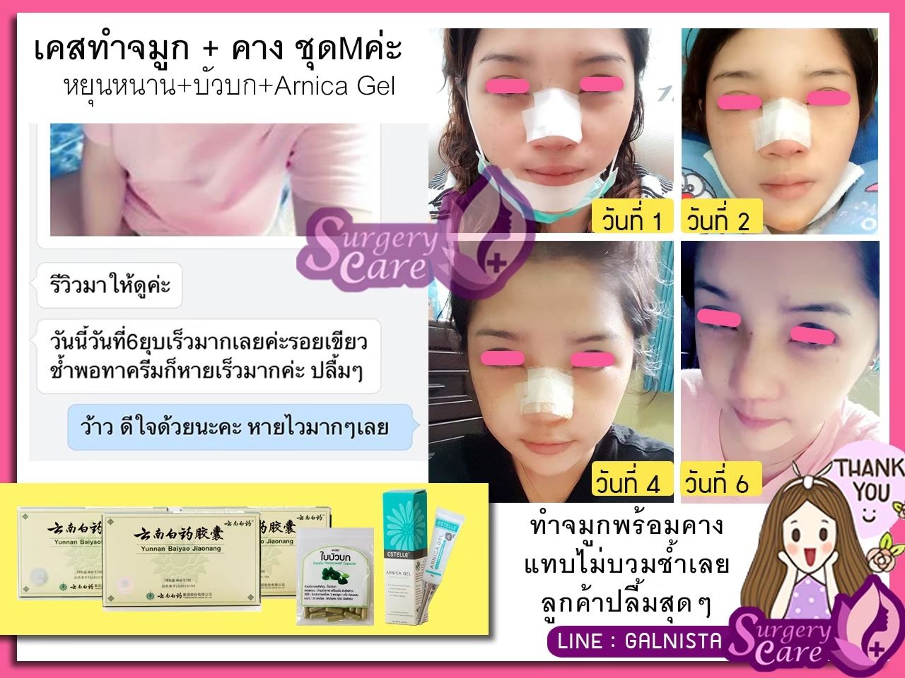 รีวิวทำจมูก,รีวิวแก้จมูก,แก้จมูกOpen,รีวิวหยุนหนานไป๋เหยา รีวิวเหล่งเอี้ยง รีวิวสมุนไพร รีวิวบัวบก รีวิวลดบวมช้ำ รีวิวศัลยกรรม รีวิวจมูก รีวิวตา รีวิวคาง รีวิวปาก รีวิวเสริมหน้าอก รีวิวดูดไขมัน รีวิว ศัลยกรรม ฟิลเลอร์ ร้อยไหม หยุนหนานไป๋เหยา Yunnanpaiyao เหล่งเอี้ยง เหล่งเอี้ยงextra surgerycare