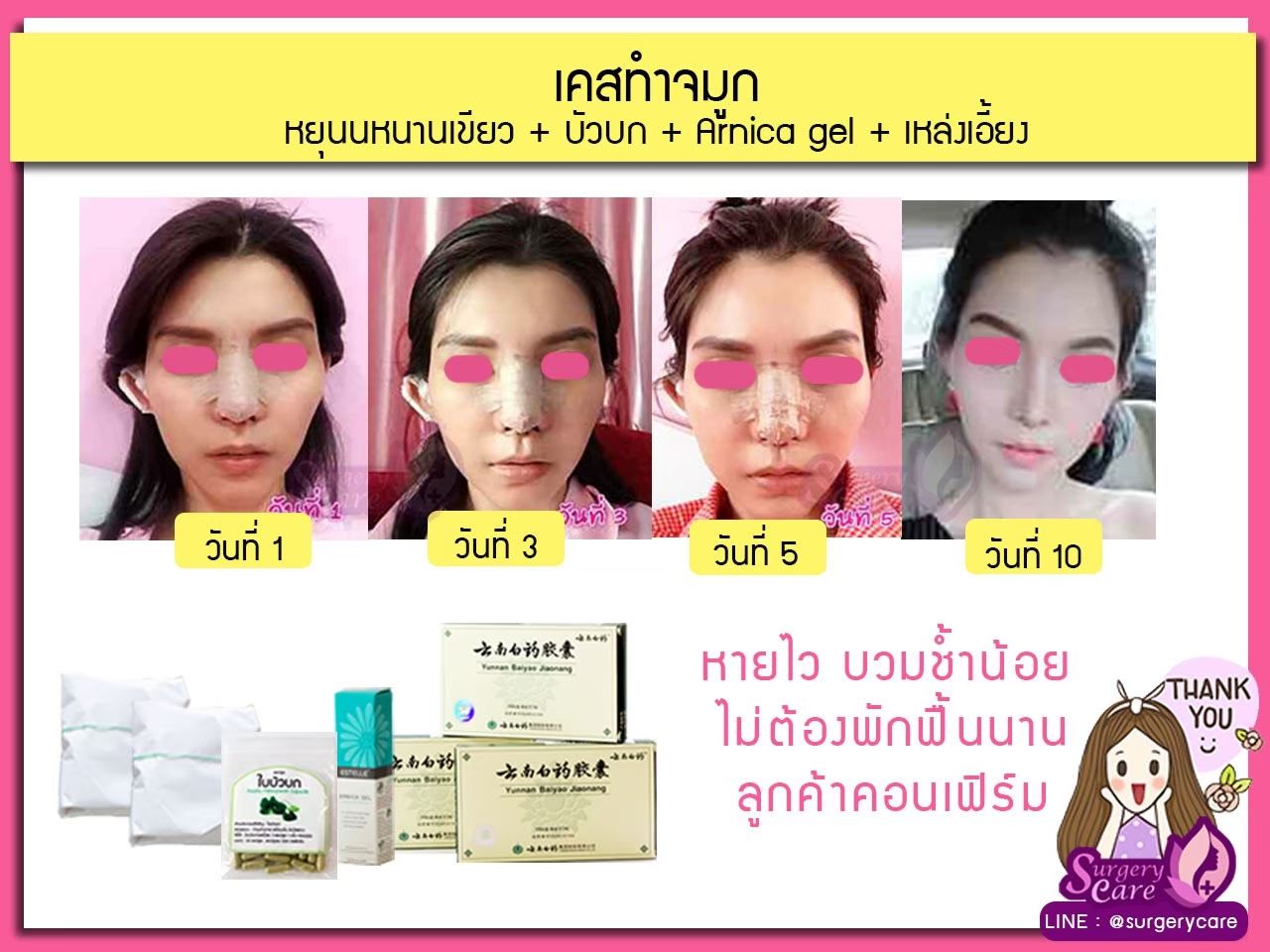 รีวิวทำจมูก,รีวิวแก้จมูก,แก้จมูกOpen,รีวิวหยุนหนานไป๋เหยา รีวิวเหล่งเอี้ยง รีวิวสมุนไพร รีวิวบัวบก รีวิวลดบวมช้ำ รีวิวศัลยกรรม รีวิวจมูก รีวิวตา รีวิวคาง รีวิวปาก รีวิวเสริมหน้าอก รีวิวดูดไขมัน รีวิว ศัลยกรรม ฟิลเลอร์ ร้อยไหม หยุนหนานไป๋เหยา Yunnanpaiyao เหล่งเอี้ยง เหล่งเอี้ยงextra surgerycare