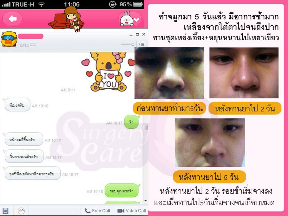 เหล่งเอี๊ยง,เหล่งเอี๊ยงExtra,ทุบดั้ง,งัดดั้ง,รีวิวิเคสแก้จมูก,ทำจมูก,เสริมจมูก,แก้จมูก,รีวิวจมูก,รีวิวแก้จมูก,รีวิวเสริมจมูก,เหล่งเอี้ยง, เหล่งเอี้ยงextra, สมุนไพรจีน, ยาลดบวมช้ำศัลยกรรม, ลดปวด, ลดอักเสบ, สมานแผล, ทำศัยกรรมอยากหายไว, เหล่งเอี้ยงของแท้, เหล่งเอี้ยง, เหล่งเอี้ยงextra, แผลหายไว, พักฟื้น, เขียวช้ำ, ลดบวมซ้ำ, ฟื้นตัว, หายไว, ยาลดบวม, รีวิวดูดไขมัน,รีวิวทำหน้าวีเชฟ,รีวิวทุบหน้า, หยุนหนานไป๋เหยา, หยุนหนานไป๋เหยากล่องเขียว, Yunnanpaiyao, สมุนไพรจีน, ยาลดบวมช้ำศัลยกรรม, ทำศัยกรรมอยากหายไว, หยุนหนานไป๋หยาของแท้, Surgerycare,