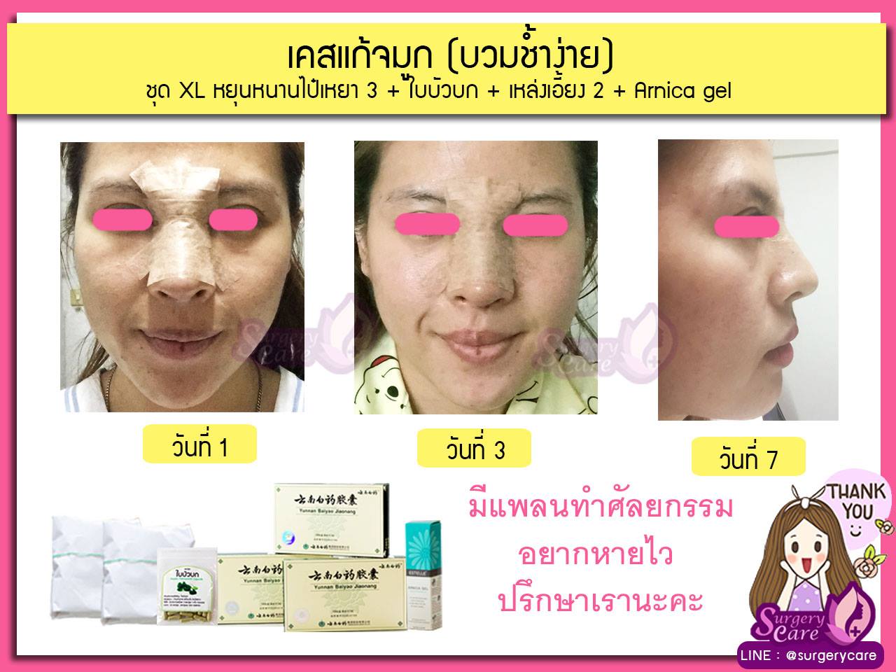 รีวิวแก้จมูก, รีวิวแก้จมูกOpen, รีวิวแก้จมูกกระดูกอ่อนหลังหู,เหล่งเอี้ยง,เหล่งเอี้ยงextra ,สมุนไพรจีน,ยาลดบวมช้ำศัลยกรรม, ลดปวด, ลดอักเสบ, สมานแผล, ทำศัยกรรมอยากหายไว, เหล่งเอี้ยงของแท้, เหล่งเอี้ยง, เหล่งเอี้ยงextra, แผลหายไว, พักฟื้นน้อย, เขียวช้ำ, ลดบวมซ้ำ,ฟื้นตัวไว, หายไว, ยาลดบวม, หยุนหนานไป๋เหยา, หยุนหนานไป๋เหยากล่องเขียว, Yunnanpaiyao,สมุนไพรจีน, ยาลดบวมช้ำศัลยกรรม, ทำศัยกรรมอยากหายไว, หยุนหนานไป๋หยาของแท้, Surgerycare,
