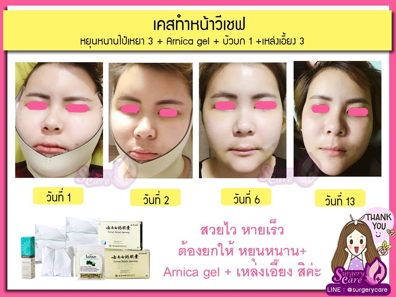 Yunnanpaiyao ,สมุนไพรจีน ,ยาลดบวมช้ำศัลยกรรม ,ลดปวด ,ลดอักเสบ ,สมานแผล ,ศัลยกรรม ,หายไว ,แผลหายไว ,พักฟื้น ,เขียวช้ำ ,ลดบวมซ้ำ ,ฟื้นตัว ,หายไว Yunnanpaiyao ,สมุนไพรจีน ,ยาลดบวมช้ำศัลยกรรม ,ลดปวด ,ลดอักเสบ ,สมานแผล ,ศัลยกรรม ,หายไว ,แผลหายไว ,พักฟื้น ,เขียวช้ำ ,ลดบวมซ้ำ ,ฟื้นตัว ,หายไว