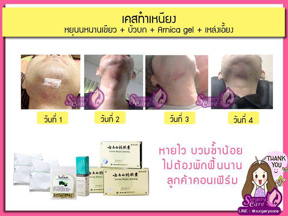 รีวิวร้อยไหม, รีวิวลดบวมช้ำ, รีวิวศัลยกรรม, ศัลยกรรม, ฟิลเลอร์, หยุนหนานไป๋เหยา, Yunnanpaiyao, เหล่งเอี้ยง, เหล่งเอี้ยงextra ,surgerycare, review, รีวิวผ่าตัด,