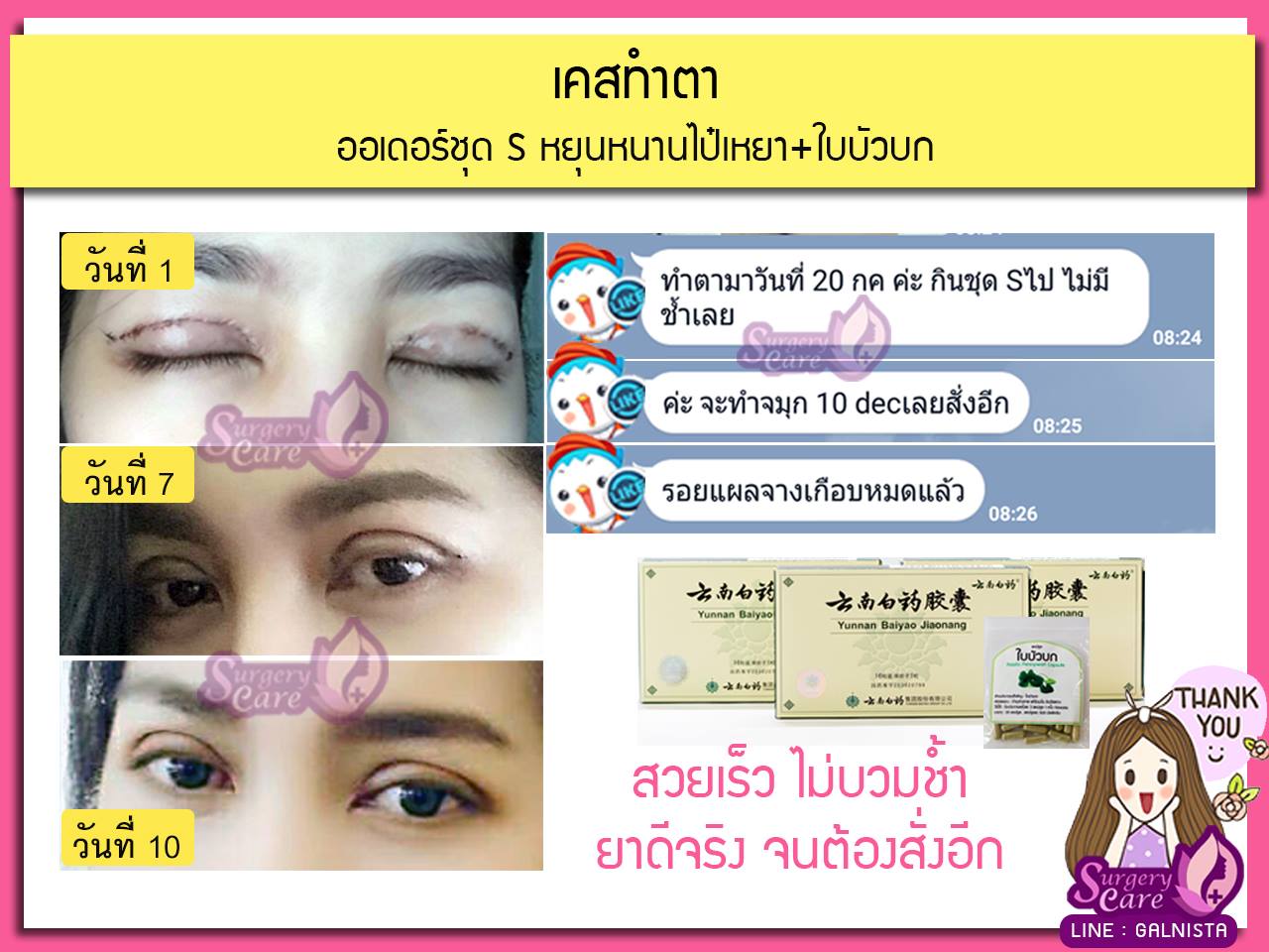 รีวิวทำตา,แก้ตา,ทำตา,ตา2ชั้น,รีวิวศัลยกรรมตา2ชั้น,รีวิวผ่าตา,รีวิวทำตา,รีวิวทำตาสองชั้น,รีวิวลดบวมช้ำ รีวิวศัลยกรรม,รีวิว, ศัลยกรรม, หยุนหนานไป๋เหยา, Yunnanpaiyao, เหล่งเอี้ยง, เหล่งเอี้ยงextra, surgerycare, review, รีวิวผ่าตัด