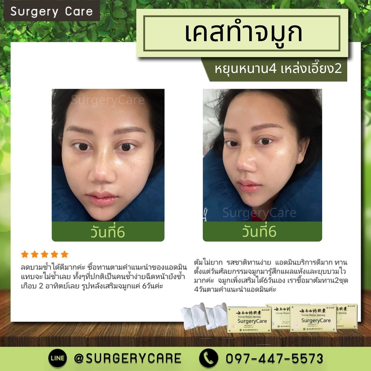 รีวิวหยุนหนานไป๋เหยา,รีวิวเหล่งเอี๊ยง,รีวิวสมุนไพร,รีวิวลดบวมช้ำ,รีวิวศัลยกรรม, รีวิวจมูก, รีวิวตา, รีวิวคาง ,รีวิวปาก, รีวิวเสริมหน้าอก, รีวิวดูดไขมัน, รีวิวศัลยกรรม, ฟิลเลอร์, ร้อยไหม, หยุนหนานไป๋เหยา ,Yunnanpaiyao, เหล่งเอี้ยงextra ,surgerycare, review, รีวิวผ่าตัด