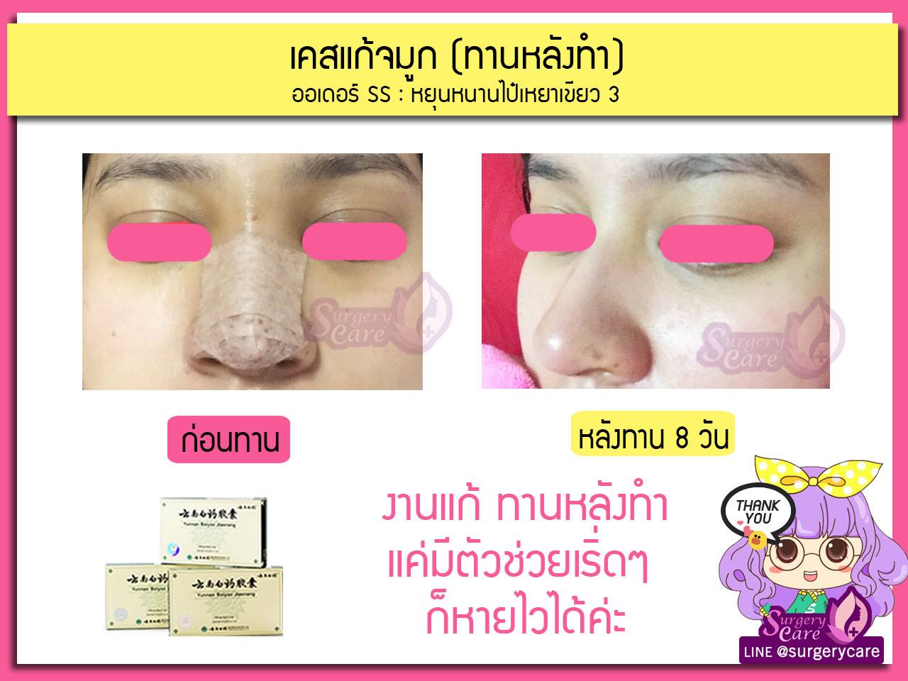 รีวิวจมูกทานหลังทำ,รีวิวจมูก,เหล่งเอี้ยง,เหล่งเอี้ยงextra ,สมุนไพรจีน,ยาลดบวมช้ำศัลยกรรม, ลดปวด, ลดอักเสบ, สมานแผล, ทำศัยกรรมอยากหายไว, เหล่งเอี้ยงของแท้, เหล่งเอี้ยง, เหล่งเอี้ยงextra, แผลหายไว, พักฟื้นน้อย, เขียวช้ำ, ลดบวมซ้ำ,ฟื้นตัวไว, หายไว, ยาลดบวม, หยุนหนานไป๋เหยา, หยุนหนานไป๋เหยากล่องเขียว, Yunnanpaiyao,สมุนไพรจีน, ยาลดบวมช้ำศัลยกรรม, ทำศัยกรรมอยากหายไว, หยุนหนานไป๋หยาของแท้, Surgerycare,