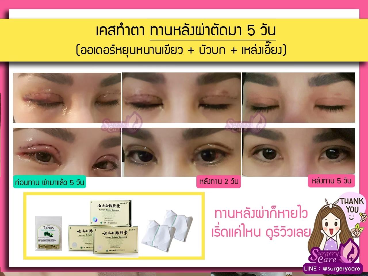 รีวิวหลังผ่า,รีวิวทำตา,บวมช้ำน้อย,หายไว,เหล่งเอี้ยง,เหล่งเอี้ยงextra ,สมุนไพรจีน,ยาลดบวมช้ำศัลยกรรม, ลดปวด, ลดอักเสบ, สมานแผล, ทำศัยกรรมอยากหายไว, เหล่งเอี้ยงของแท้, เหล่งเอี้ยง, เหล่งเอี้ยงextra, แผลหายไว, พักฟื้นน้อย, เขียวช้ำ, ลดบวมซ้ำ,ฟื้นตัวไว, หายไว, ยาลดบวม, หยุนหนานไป๋เหยา, หยุนหนานไป๋เหยากล่องเขียว, Yunnanpaiyao,สมุนไพรจีน, ยาลดบวมช้ำศัลยกรรม, ทำศัยกรรมอยากหายไว, หยุนหนานไป๋หยาของแท้, Surgerycare,