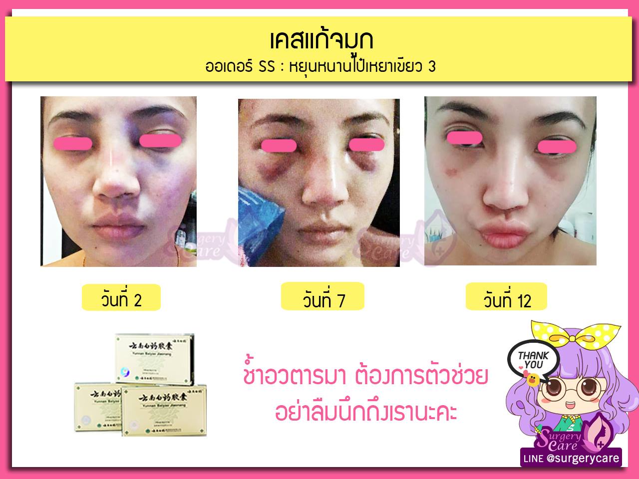 รีวิวแก้จมูก,รีวิวเสริมจมูก, รีวิวแก้จมูกOpen,บวมช้ำน้อย,หายไว, เหล่งเอี้ยง,เหล่งเอี้ยงextra ,สมุนไพรจีน,ยาลดบวมช้ำศัลยกรรม, ลดปวด, ลดอักเสบ, สมานแผล, ทำศัยกรรมอยากหายไว, เหล่งเอี้ยงของแท้, เหล่งเอี้ยง, เหล่งเอี้ยงextra, แผลหายไว, พักฟื้นน้อย, เขียวช้ำ, ลดบวมซ้ำ,ฟื้นตัวไว, หายไว, ยาลดบวม, หยุนหนานไป๋เหยา, หยุนหนานไป๋เหยากล่องเขียว, Yunnanpaiyao,สมุนไพรจีน, ยาลดบวมช้ำศัลยกรรม, ทำศัยกรรมอยากหายไว, หยุนหนานไป๋หยาของแท้, Surgerycare,