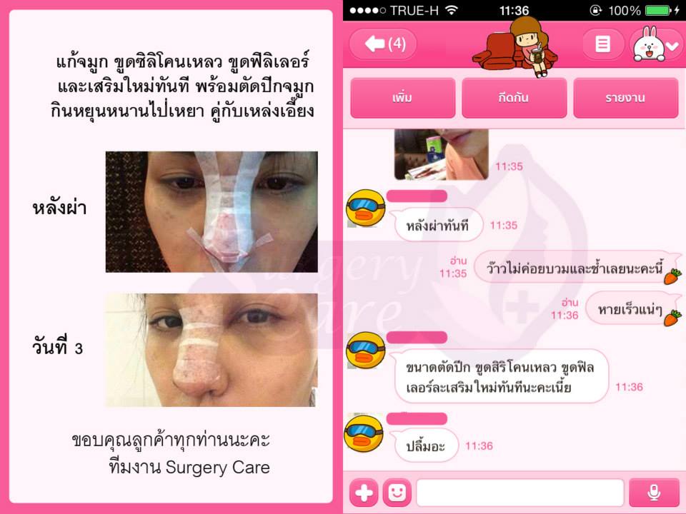 รีวิวแก้จมูก,รีวิวแก้จมูกขูดของเหลว,เหล่งเอี้ยง, เหล่งเอี้ยงextra, สมุนไพรจีน, ยาลดบวมช้ำศัลยกรรม, ลดปวด, ลดอักเสบ, สมานแผล, ทำศัยกรรมอยากหายไว, เหล่งเอี้ยงของแท้, เหล่งเอี้ยง, เหล่งเอี้ยงextra, แผลหายไว, พักฟื้น, เขียวช้ำ, ลดบวมซ้ำ, ฟื้นตัว, หายไว, ยาลดบวม, รีวิวดูดไขมัน,รีวิวทำหน้าวีเชฟ,รีวิวทุบหน้า, หยุนหนานไป๋เหยา, หยุนหนานไป๋เหยากล่องเขียว, Yunnanpaiyao, สมุนไพรจีน, ยาลดบวมช้ำศัลยกรรม, ทำศัยกรรมอยากหายไว, หยุนหนานไป๋หยาของแท้, Surgerycare,