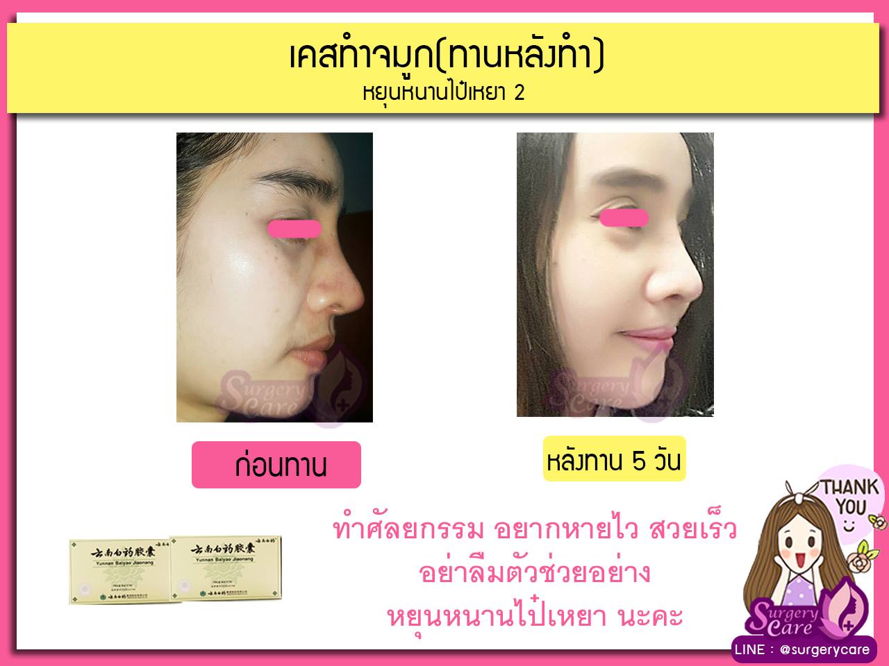 รีวิวจมูกทานหลังทำ,รีวิวจมูก,เหล่งเอี้ยง,เหล่งเอี้ยงextra ,สมุนไพรจีน,ยาลดบวมช้ำศัลยกรรม, ลดปวด, ลดอักเสบ, สมานแผล, ทำศัยกรรมอยากหายไว, เหล่งเอี้ยงของแท้, เหล่งเอี้ยง, เหล่งเอี้ยงextra, แผลหายไว, พักฟื้นน้อย, เขียวช้ำ, ลดบวมซ้ำ,ฟื้นตัวไว, หายไว, ยาลดบวม, หยุนหนานไป๋เหยา, หยุนหนานไป๋เหยากล่องเขียว, Yunnanpaiyao,สมุนไพรจีน, ยาลดบวมช้ำศัลยกรรม, ทำศัยกรรมอยากหายไว, หยุนหนานไป๋หยาของแท้, Surgerycare,