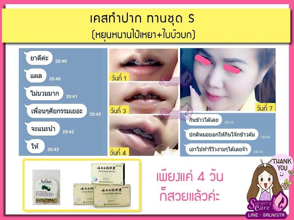 รีวิวทำปาก รีวิวหยุนหนานไป๋เหยา,รีวิวเหล่งเอี๊ยง,รีวิวสมุนไพร,รีวิวลดบวมช้ำ,รีวิวศัลยกรรม, รีวิวจมูก, รีวิวตา, รีวิวคาง , รีวิวเสริมหน้าอก, รีวิวดูดไขมัน, รีวิวศัลยกรรม, ฟิลเลอร์, ร้อยไหม, หยุนหนานไป๋เหยา ,Yunnanpaiyao, เหล่งเอี้ยงextra ,surgerycare, review, รีวิวผ่าตัด 