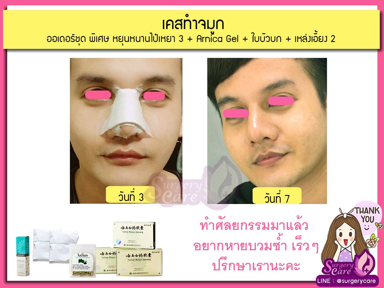 งัดดั้ง,เสริมจมูก,รีวิวทำจมูก,รีวิวแก้จมูก,แก้จมูกOpen,รีวิวหยุนหนานไป๋เหยา รีวิวเหล่งเอี้ยง รีวิวสมุนไพร รีวิวบัวบก รีวิวลดบวมช้ำ รีวิวศัลยกรรม รีวิวจมูก รีวิวตา รีวิวคาง รีวิวปาก รีวิวเสริมหน้าอก รีวิวดูดไขมัน รีวิว ศัลยกรรม ฟิลเลอร์ ร้อยไหม หยุนหนานไป๋เหยา Yunnanpaiyao เหล่งเอี้ยง เหล่งเอี้ยงextra surgerycare