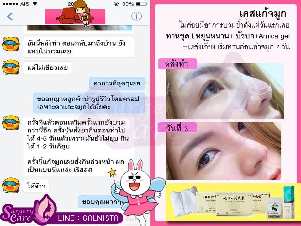 รีวิวทำจมูก รีวิวหยุนหนานไป๋เหยา เหล่งเอี๊ยงExtra
