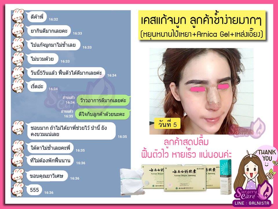 งัดดั้ง,เสริมจมูก,รีวิวทำจมูก,รีวิวแก้จมูก,แก้จมูกOpen,รีวิวหยุนหนานไป๋เหยา รีวิวเหล่งเอี้ยง รีวิวสมุนไพร รีวิวบัวบก รีวิวลดบวมช้ำ รีวิวศัลยกรรม รีวิวจมูก รีวิวตา รีวิวคาง รีวิวปาก รีวิวเสริมหน้าอก รีวิวดูดไขมัน รีวิว ศัลยกรรม ฟิลเลอร์ ร้อยไหม หยุนหนานไป๋เหยา Yunnanpaiyao เหล่งเอี้ยง เหล่งเอี้ยงextra surgerycare