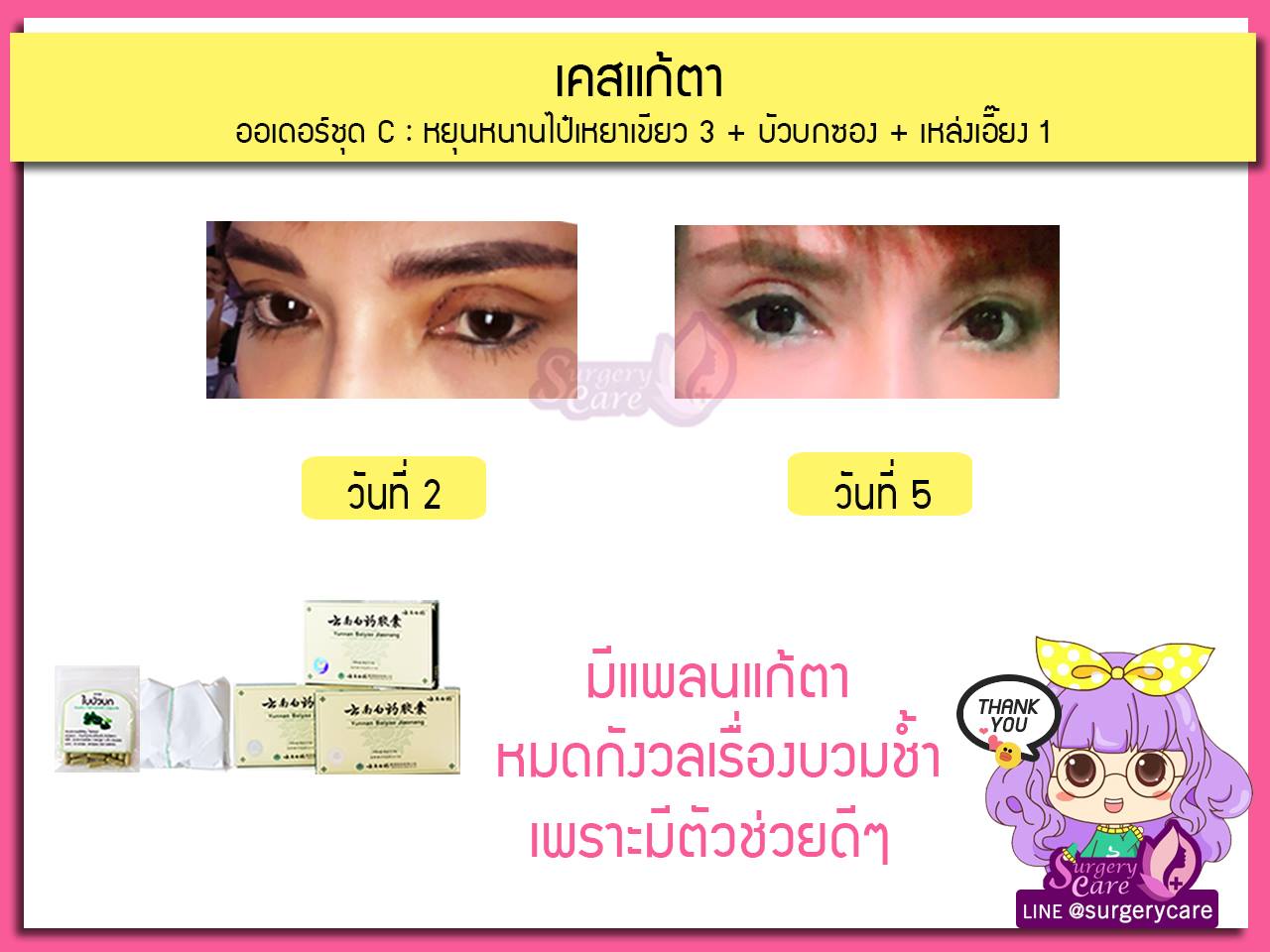 ทำตา,ตา2ชั้น,รีวิวศัลยกรรมตา2ชั้น,รีวิวผ่าตา,รีวิวทำตา,รีวิวทำตาสองชั้น,รีวิวลดบวมช้ำ รีวิวศัลยกรรม,รีวิว, ศัลยกรรม, หยุนหนานไป๋เหยา, Yunnanpaiyao, เหล่งเอี้ยง, เหล่งเอี้ยงextra, surgerycare, review, รีวิวผ่าตัด