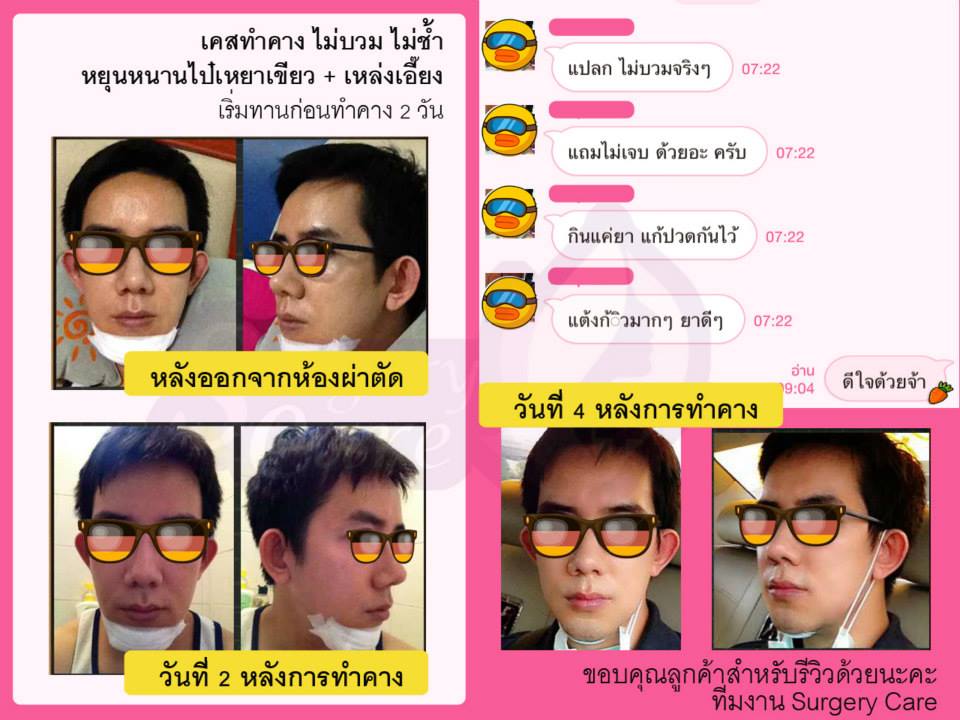 รีวิวทำคาง,เหล่งเอี้ยง, เหล่งเอี้ยงextra, สมุนไพรจีน, ยาลดบวมช้ำศัลยกรรม, ลดปวด, ลดอักเสบ, สมานแผล, ทำศัยกรรมอยากหายไว, เหล่งเอี้ยงของแท้, เหล่งเอี้ยง, เหล่งเอี้ยงextra, แผลหายไว, พักฟื้น, เขียวช้ำ, ลดบวมซ้ำ, ฟื้นตัว, หายไว, ยาลดบวม, รีวิวดูดไขมัน,รีวิวทำหน้าวีเชฟ,รีวิวทุบหน้า, หยุนหนานไป๋เหยา, หยุนหนานไป๋เหยากล่องเขียว, Yunnanpaiyao, สมุนไพรจีน, ยาลดบวมช้ำศัลยกรรม, ทำศัยกรรมอยากหายไว, หยุนหนานไป๋หยาของแท้, Surgerycare,