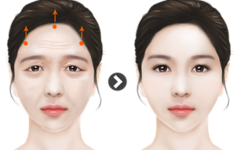 Endotine คืออะไร ใครควรทำ