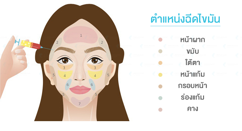 ฉีดไขมัน,เติมไขมัน,ฉีดไขมันหน้าเด็ก,หยุนหนานไป๋เหยา,Yunnanpaiyao,สมุนไพรจีน,เหล่งเอี๊ยงextra,ยาลดบวมช้ำศัลยกรรม,ลดปวด,ลดอักเสบ,สมานแผล,ศัลยกรรม,หายไว,แผลหายไว,พักฟื้น,เขียวช้ำ,ลดบวมซ้ำ,ฟื้นตัวหายไว,ยาลดบวม,Surgerycare,จมูก,ตา,คาง,ปาก,หน้าอก,ดูดไขมัน ,ทำหน้า ,ผ่าตัด ,ของแท้ ฉีดไขมัน,เติมไขมัน,ฉีดไขมันหน้าเด็ก,หยุนหนานไป๋เหยา,Yunnanpaiyao,สมุนไพรจีน,เหล่งเอี๊ยงextra,ยาลดบวมช้ำศัลยกรรม,ลดปวด,ลดอักเสบ,สมานแผล,ศัลยกรรม,หายไว,แผลหายไว,พักฟื้น,เขียวช้ำ,ลดบวมซ้ำ,ฟื้นตัวหายไว,ยาลดบวม,Surgerycare,จมูก,ตา,คาง,ปาก,หน้าอก,ดูดไขมัน ,ทำหน้า ,ผ่าตัด ,ของแท้