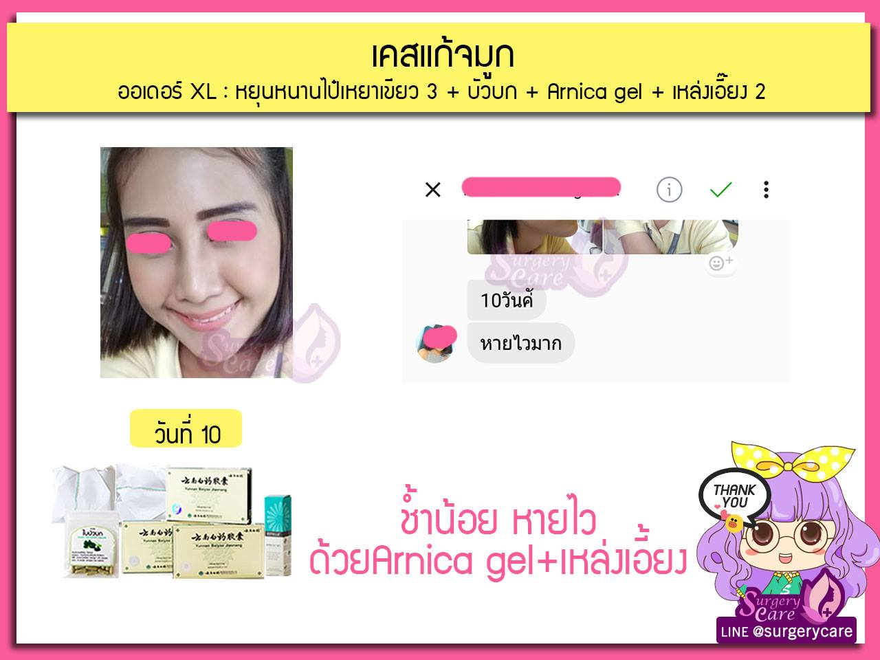 รีวิวแก้จมูก, รีวิวแก้จมูกOpen, รีวิวแก้จมูกกระดูกอ่อนหลังหู,เหล่งเอี้ยง,เหล่งเอี้ยงextra ,สมุนไพรจีน,ยาลดบวมช้ำศัลยกรรม, ลดปวด, ลดอักเสบ, สมานแผล, ทำศัยกรรมอยากหายไว, เหล่งเอี้ยงของแท้, เหล่งเอี้ยง, เหล่งเอี้ยงextra, แผลหายไว, พักฟื้นน้อย, เขียวช้ำ, ลดบวมซ้ำ,ฟื้นตัวไว, หายไว, ยาลดบวม, หยุนหนานไป๋เหยา, หยุนหนานไป๋เหยากล่องเขียว, Yunnanpaiyao,สมุนไพรจีน, ยาลดบวมช้ำศัลยกรรม, ทำศัยกรรมอยากหายไว, หยุนหนานไป๋หยาของแท้, Surgerycare,