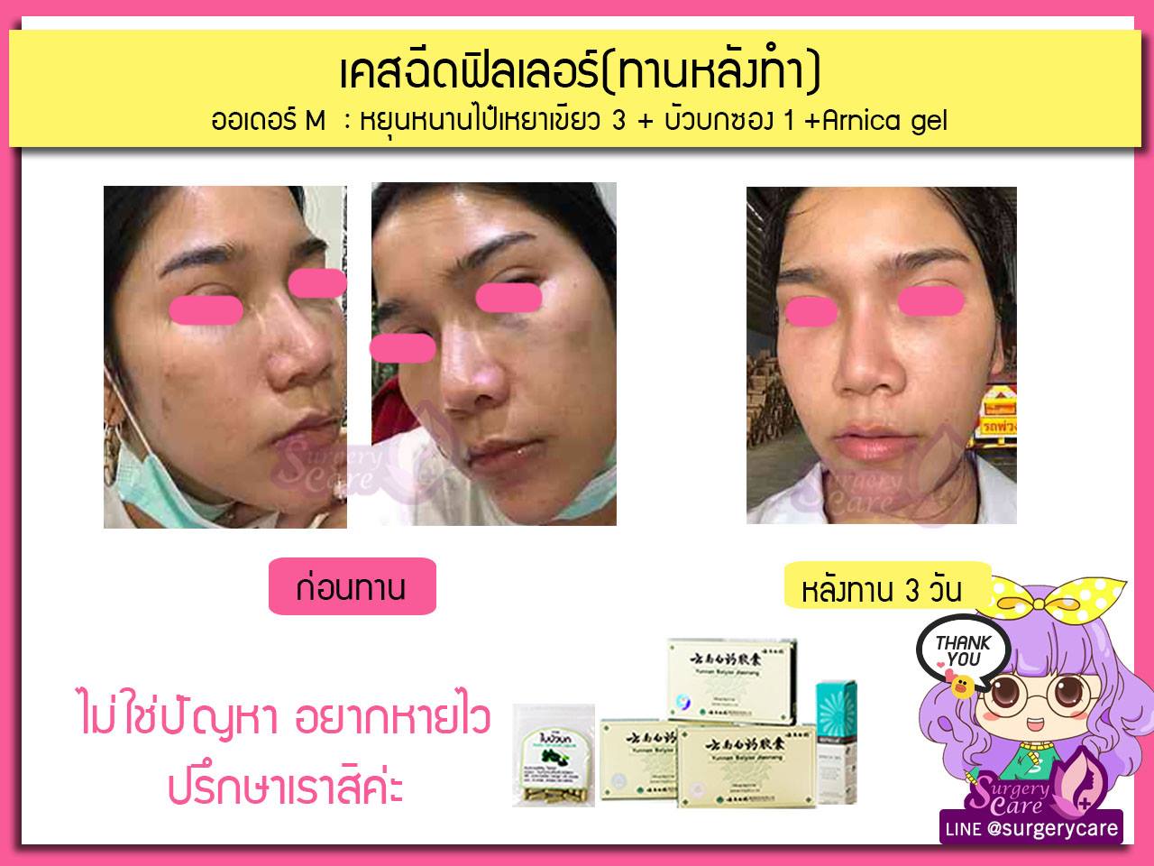 รีวิวจมูกทานหลังทำ,รีวิวจมูก,เหล่งเอี้ยง,เหล่งเอี้ยงextra ,สมุนไพรจีน,ยาลดบวมช้ำศัลยกรรม, ลดปวด, ลดอักเสบ, สมานแผล, ทำศัยกรรมอยากหายไว, เหล่งเอี้ยงของแท้, เหล่งเอี้ยง, เหล่งเอี้ยงextra, แผลหายไว, พักฟื้นน้อย, เขียวช้ำ, ลดบวมซ้ำ,ฟื้นตัวไว, หายไว, ยาลดบวม, หยุนหนานไป๋เหยา, หยุนหนานไป๋เหยากล่องเขียว, Yunnanpaiyao,สมุนไพรจีน, ยาลดบวมช้ำศัลยกรรม, ทำศัยกรรมอยากหายไว, หยุนหนานไป๋หยาของแท้, Surgerycare,