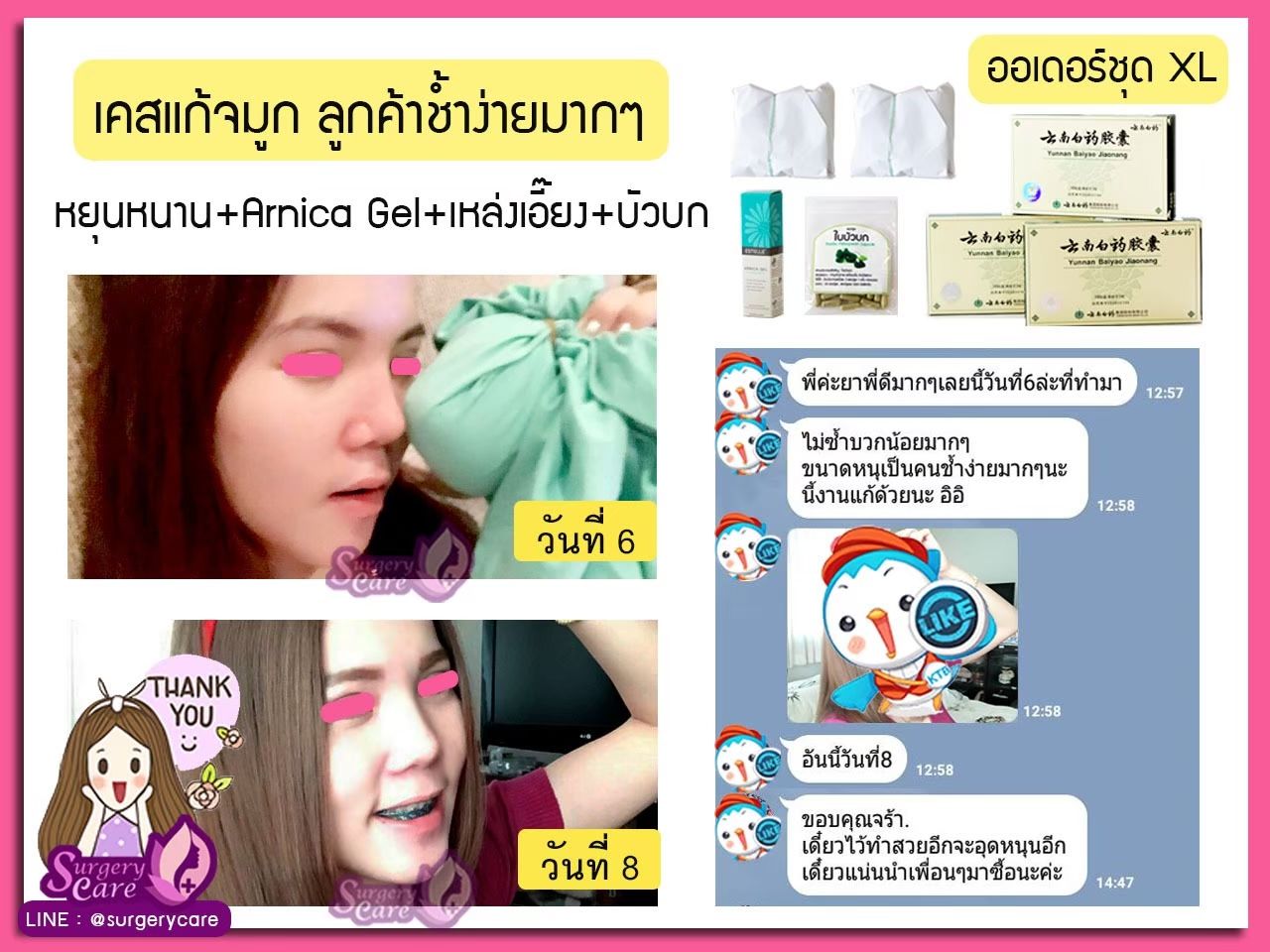 รีวิวแก้จมูก,รีวิวเสริมจมูก, รีวิวแก้จมูกOpen,บวมช้ำน้อย,หายไว, รีวิวแก้จมูกกระดูกอ่อนหลังหู,เหล่งเอี้ยง,เหล่งเอี้ยงextra ,สมุนไพรจีน,ยาลดบวมช้ำศัลยกรรม, ลดปวด, ลดอักเสบ, สมานแผล, ทำศัยกรรมอยากหายไว, เหล่งเอี้ยงของแท้, เหล่งเอี้ยง, เหล่งเอี้ยงextra, แผลหายไว, พักฟื้นน้อย, เขียวช้ำ, ลดบวมซ้ำ,ฟื้นตัวไว, หายไว, ยาลดบวม, หยุนหนานไป๋เหยา, หยุนหนานไป๋เหยากล่องเขียว, Yunnanpaiyao,สมุนไพรจีน, ยาลดบวมช้ำศัลยกรรม, ทำศัยกรรมอยากหายไว, หยุนหนานไป๋หยาของแท้, Surgerycare,