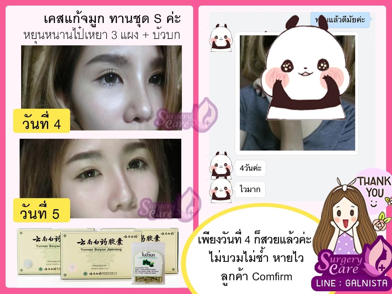 รีวิวทำจมูก,รีวิวหยุนหนานไป๋เหยา รีวิวเหล่งเอี้ยง รีวิวสมุนไพร รีวิวบัวบก รีวิวลดบวมช้ำ รีวิวศัลยกรรม รีวิวจมูก รีวิวตา รีวิวคาง รีวิวปาก รีวิวเสริมหน้าอก รีวิวดูดไขมัน รีวิว ศัลยกรรม ฟิลเลอร์ ร้อยไหม หยุนหนานไป๋เหยา Yunnanpaiyao เหล่งเอี้ยง เหล่งเอี้ยงextra surgerycare