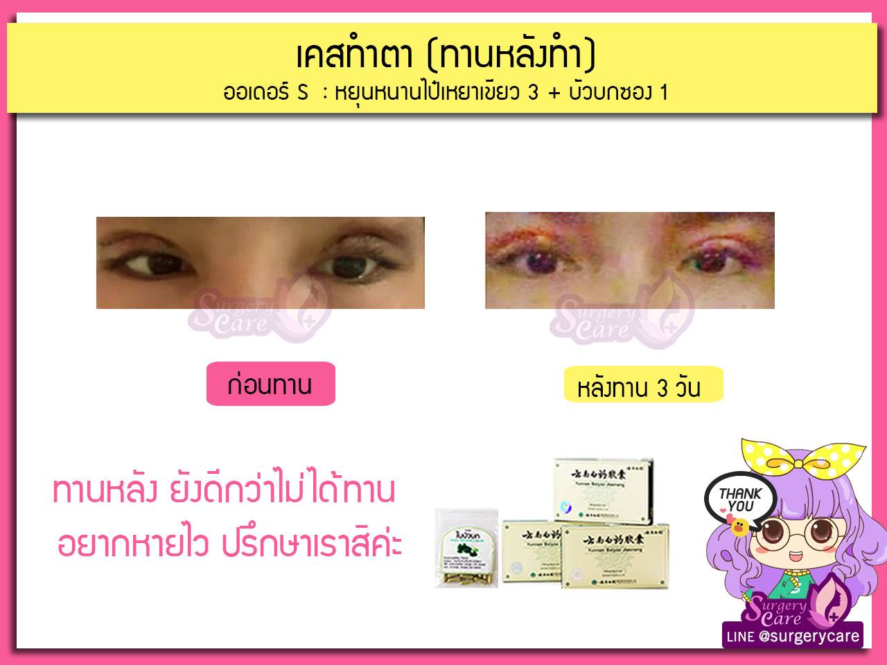 รีวิวหลังผ่า,รีวิวทำตา,บวมช้ำน้อย,หายไว,เหล่งเอี้ยง,เหล่งเอี้ยงextra ,สมุนไพรจีน,ยาลดบวมช้ำศัลยกรรม, ลดปวด, ลดอักเสบ, สมานแผล, ทำศัยกรรมอยากหายไว, เหล่งเอี้ยงของแท้, เหล่งเอี้ยง, เหล่งเอี้ยงextra, แผลหายไว, พักฟื้นน้อย, เขียวช้ำ, ลดบวมซ้ำ,ฟื้นตัวไว, หายไว, ยาลดบวม, หยุนหนานไป๋เหยา, หยุนหนานไป๋เหยากล่องเขียว, Yunnanpaiyao,สมุนไพรจีน, ยาลดบวมช้ำศัลยกรรม, ทำศัยกรรมอยากหายไว, หยุนหนานไป๋หยาของแท้, Surgerycare,