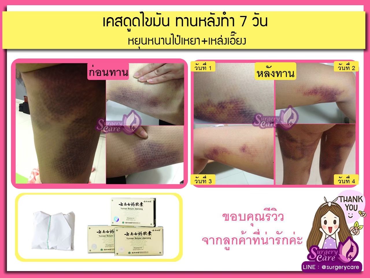 รีวิวทำดูดไขมัน รีวิวจากผู้ใช้จริง รีวิวหยุนหนานไป๋เหยา เหล่งเอี๊ยงExtra