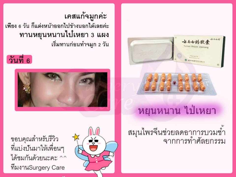 รีวิวแก้จมูก,รีวิวเสริมจมูก, รีวิวแก้จมูกOpen,บวมช้ำน้อย,หายไว, รีวิวแก้จมูกกระดูกอ่อนหลังหู,เหล่งเอี้ยง,เหล่งเอี้ยงextra ,สมุนไพรจีน,ยาลดบวมช้ำศัลยกรรม, ลดปวด, ลดอักเสบ, สมานแผล, ทำศัยกรรมอยากหายไว, เหล่งเอี้ยงของแท้, เหล่งเอี้ยง, เหล่งเอี้ยงextra, แผลหายไว, พักฟื้นน้อย, เขียวช้ำ, ลดบวมซ้ำ,ฟื้นตัวไว, หายไว, ยาลดบวม, หยุนหนานไป๋เหยา, หยุนหนานไป๋เหยากล่องเขียว, Yunnanpaiyao,สมุนไพรจีน, ยาลดบวมช้ำศัลยกรรม, ทำศัยกรรมอยากหายไว, หยุนหนานไป๋หยาของแท้, Surgerycare,