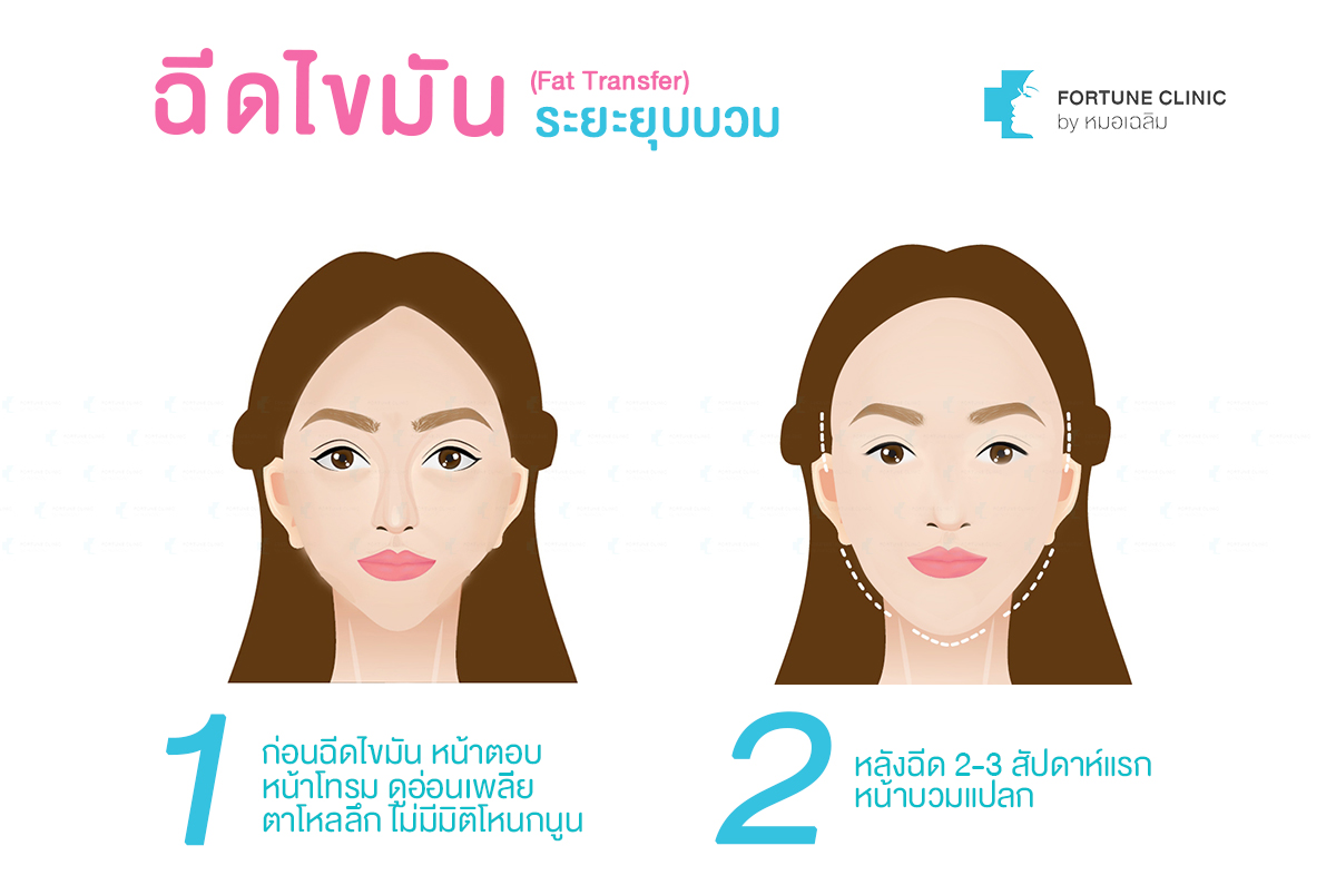 ฉีดไขมัน,เติมไขมัน,ฉีดไขมันหน้าเด็ก,หยุนหนานไป๋เหยา,Yunnanpaiyao,สมุนไพรจีน,เหล่งเอี๊ยงextra,ยาลดบวมช้ำศัลยกรรม,ลดปวด,ลดอักเสบ,สมานแผล,ศัลยกรรม,หายไว,แผลหายไว,พักฟื้น,เขียวช้ำ,ลดบวมซ้ำ,ฟื้นตัวหายไว,ยาลดบวม,Surgerycare,จมูก,ตา,คาง,ปาก,หน้าอก,ดูดไขมัน ,ทำหน้า ,ผ่าตัด ,ของแท้ ฉีดไขมัน,เติมไขมัน,ฉีดไขมันหน้าเด็ก,หยุนหนานไป๋เหยา,Yunnanpaiyao,สมุนไพรจีน,เหล่งเอี๊ยงextra,ยาลดบวมช้ำศัลยกรรม,ลดปวด,ลดอักเสบ,สมานแผล,ศัลยกรรม,หายไว,แผลหายไว,พักฟื้น,เขียวช้ำ,ลดบวมซ้ำ,ฟื้นตัวหายไว,ยาลดบวม,Surgerycare,จมูก,ตา,คาง,ปาก,หน้าอก,ดูดไขมัน ,ทำหน้า ,ผ่าตัด ,ของแท้