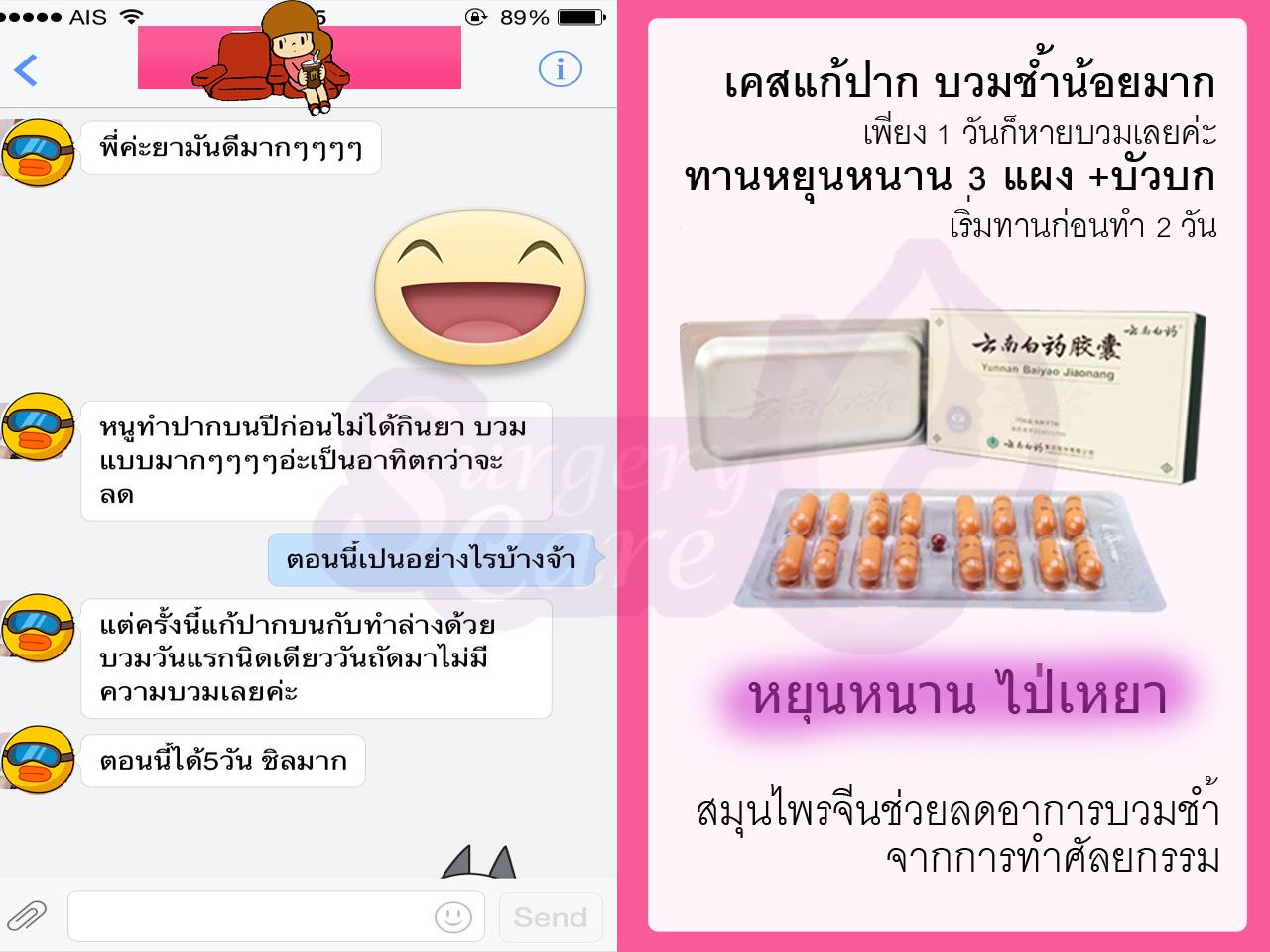 ทำปาก,รีวิวตัดปาก,รีวิวทำปาก,รีวิวทำปากกระจับ, รีวิวหยุนหนานไป๋เหยา,รีวิวเหล่งเอี๊ยง,รีวิวสมุนไพร,รีวิวลดบวมช้ำ,รีวิวศัลยกรรม, รีวิวจมูก, รีวิวตา, รีวิวคาง , รีวิวเสริมหน้าอก, รีวิวดูดไขมัน, รีวิวศัลยกรรม, ฟิลเลอร์, ร้อยไหม, หยุนหนานไป๋เหยา ,Yunnanpaiyao, เหล่งเอี้ยงextra ,surgerycare, review, รีวิวผ่าตัด 
