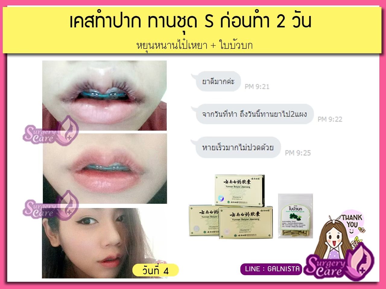 รีวิวทำปาก,รีวิวทำปากกระจับ, รีวิวหยุนหนานไป๋เหยา,รีวิวเหล่งเอี๊ยง,รีวิวสมุนไพร,รีวิวลดบวมช้ำ,รีวิวศัลยกรรม, รีวิวจมูก, รีวิวตา, รีวิวคาง , รีวิวเสริมหน้าอก, รีวิวดูดไขมัน, รีวิวศัลยกรรม, ฟิลเลอร์, ร้อยไหม, หยุนหนานไป๋เหยา ,Yunnanpaiyao, เหล่งเอี้ยงextra ,surgerycare, review, รีวิวผ่าตัด 