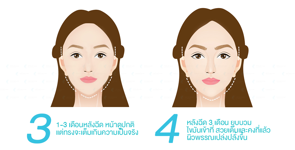 ฉีดไขมัน,เติมไขมัน,ฉีดไขมันหน้าเด็ก,หยุนหนานไป๋เหยา,Yunnanpaiyao,สมุนไพรจีน,เหล่งเอี๊ยงextra,ยาลดบวมช้ำศัลยกรรม,ลดปวด,ลดอักเสบ,สมานแผล,ศัลยกรรม,หายไว,แผลหายไว,พักฟื้น,เขียวช้ำ,ลดบวมซ้ำ,ฟื้นตัวหายไว,ยาลดบวม,Surgerycare,จมูก,ตา,คาง,ปาก,หน้าอก,ดูดไขมัน ,ทำหน้า ,ผ่าตัด ,ของแท้ ฉีดไขมัน,เติมไขมัน,ฉีดไขมันหน้าเด็ก,หยุนหนานไป๋เหยา,Yunnanpaiyao,สมุนไพรจีน,เหล่งเอี๊ยงextra,ยาลดบวมช้ำศัลยกรรม,ลดปวด,ลดอักเสบ,สมานแผล,ศัลยกรรม,หายไว,แผลหายไว,พักฟื้น,เขียวช้ำ,ลดบวมซ้ำ,ฟื้นตัวหายไว,ยาลดบวม,Surgerycare,จมูก,ตา,คาง,ปาก,หน้าอก,ดูดไขมัน ,ทำหน้า ,ผ่าตัด ,ของแท้