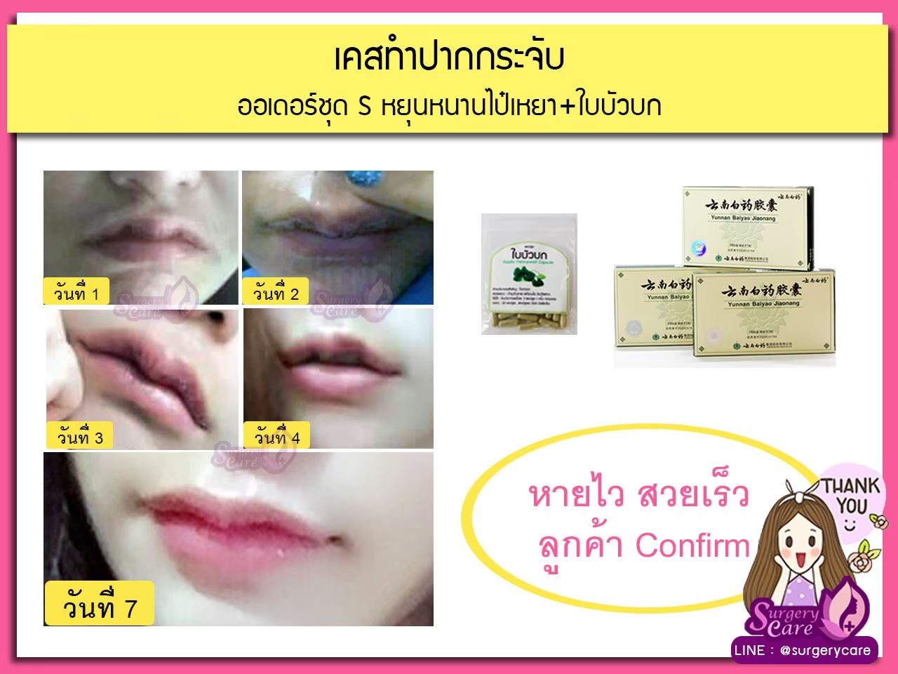 รีวิวทำปาก,รีวิวทำปากกระจับ, รีวิวหยุนหนานไป๋เหยา,รีวิวเหล่งเอี๊ยง,รีวิวสมุนไพร,รีวิวลดบวมช้ำ,รีวิวศัลยกรรม, รีวิวจมูก, รีวิวตา, รีวิวคาง , รีวิวเสริมหน้าอก, รีวิวดูดไขมัน, รีวิวศัลยกรรม, ฟิลเลอร์, ร้อยไหม, หยุนหนานไป๋เหยา ,Yunnanpaiyao, เหล่งเอี้ยงextra ,surgerycare, review, รีวิวผ่าตัด 