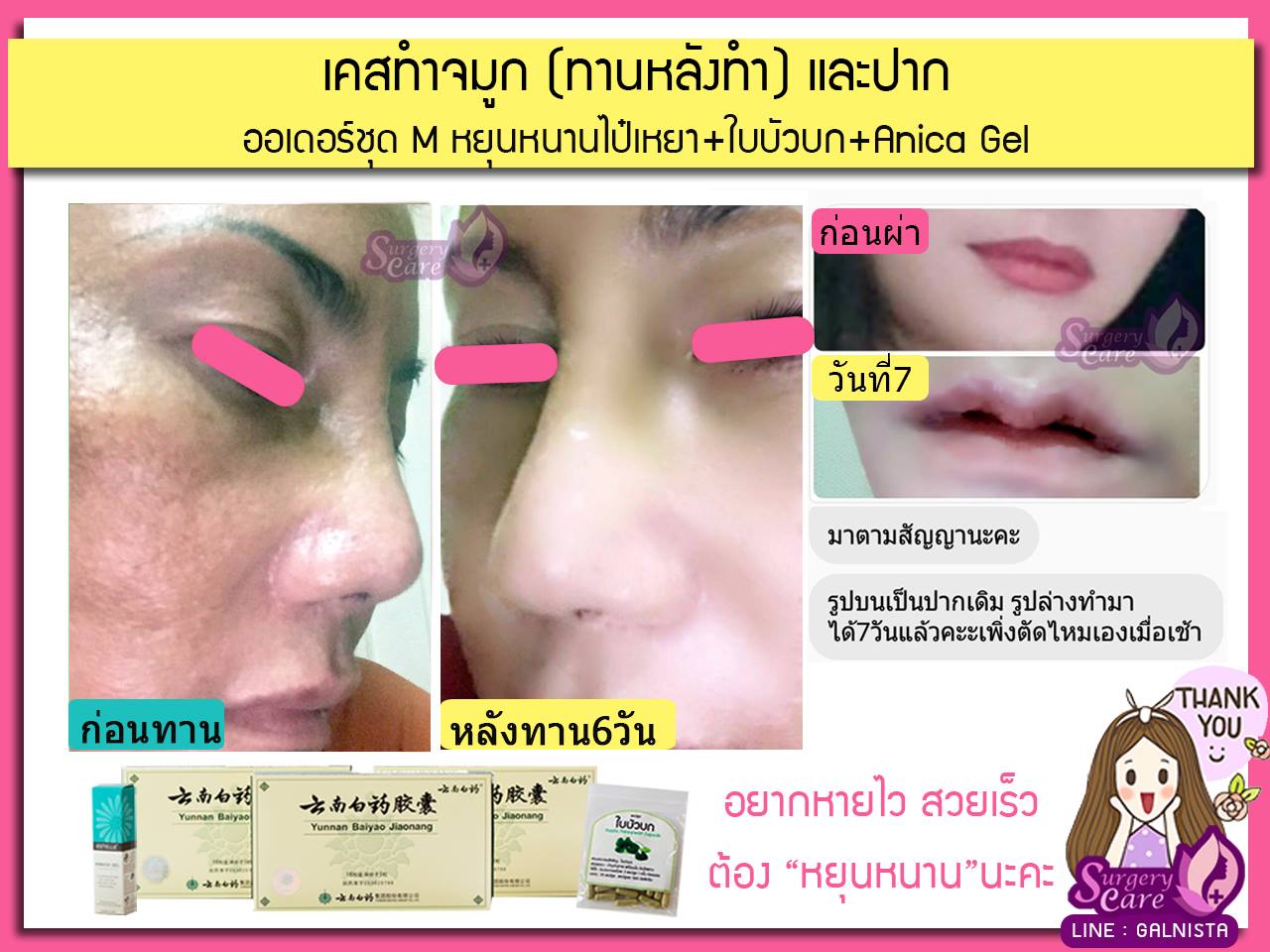 รีวิวตัดปาก,รีวิวทำปาก,รีวิวทำปากกระจับ, รีวิวหยุนหนานไป๋เหยา,รีวิวเหล่งเอี๊ยง,รีวิวสมุนไพร,รีวิวลดบวมช้ำ,รีวิวศัลยกรรม, รีวิวจมูก, รีวิวตา, รีวิวคาง , รีวิวเสริมหน้าอก, รีวิวดูดไขมัน, รีวิวศัลยกรรม, ฟิลเลอร์, ร้อยไหม, หยุนหนานไป๋เหยา ,Yunnanpaiyao, เหล่งเอี้ยงextra ,surgerycare, review, รีวิวผ่าตัด 