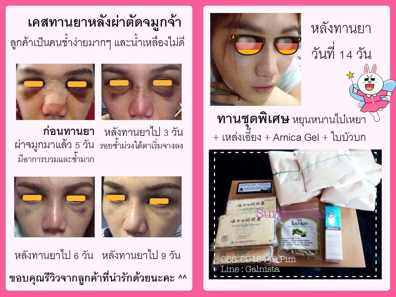 รีวิวทำจมูก, บวมช้ำน้อย,หายไว,เหล่งเอี้ยง,เหล่งเอี้ยงextra ,สมุนไพรจีน,ยาลดบวมช้ำศัลยกรรม, ลดปวด, ลดอักเสบ, สมานแผล, ทำศัยกรรมอยากหายไว, เหล่งเอี้ยงของแท้, เหล่งเอี้ยง, เหล่งเอี้ยงextra, แผลหายไว, พักฟื้นน้อย, เขียวช้ำ, ลดบวมซ้ำ,ฟื้นตัวไว, หายไว, ยาลดบวม, หยุนหนานไป๋เหยา, หยุนหนานไป๋เหยากล่องเขียว, Yunnanpaiyao,สมุนไพรจีน, ยาลดบวมช้ำศัลยกรรม, ทำศัยกรรมอยากหายไว, หยุนหนานไป๋หยาของแท้, Surgerycare,