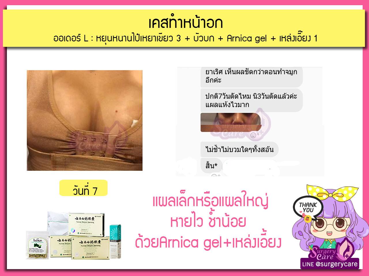 รีวิวเสริมหน้าอก,รีวิวทำนม,รีวิวหยุนหนานไป๋เหยา, รีวิวเหล่งเอี้ยง, รีวิวบัวบก, รีวิวสมุนไพร, รีวิวลดบวมช้ำ, รีวิวศัลยกรรม,รีวิว ศัลยกรรม, ฟิลเลอร์, ร้อยไหม, หยุนหนานไป๋เหยา, Yunnanpaiyao, เหล่งเอี้ยง, เหล่งเอี้ยงextra, surgerycare review ,รีวิวผ่าตัด , รีวิวเสริมหน้าอก,รีวิวทำนม,รีวิวหยุนหนานไป๋เหยา, รีวิวเหล่งเอี้ยง, รีวิวบัวบก, รีวิวสมุนไพร, รีวิวลดบวมช้ำ, รีวิวศัลยกรรม,รีวิว ศัลยกรรม, ฟิลเลอร์, ร้อยไหม, หยุนหนานไป๋เหยา, Yunnanpaiyao, เหล่งเอี้ยง, เหล่งเอี้ยงextra, surgerycare review ,รีวิวผ่าตัด ,