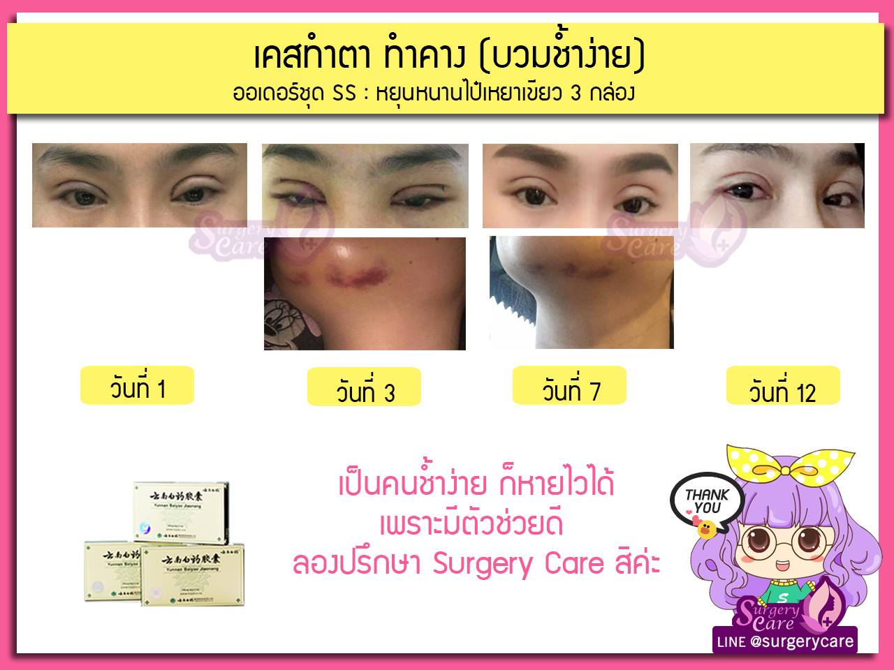 รีวิวทำตา,แก้ตา,ทำตา,ตา2ชั้น,รีวิวศัลยกรรมตา2ชั้น,รีวิวผ่าตา,รีวิวทำตา,รีวิวทำตาสองชั้น,รีวิวลดบวมช้ำ รีวิวศัลยกรรม,รีวิว, ศัลยกรรม, หยุนหนานไป๋เหยา, Yunnanpaiyao, เหล่งเอี้ยง, เหล่งเอี้ยงextra, surgerycare, review, รีวิวผ่าตัด