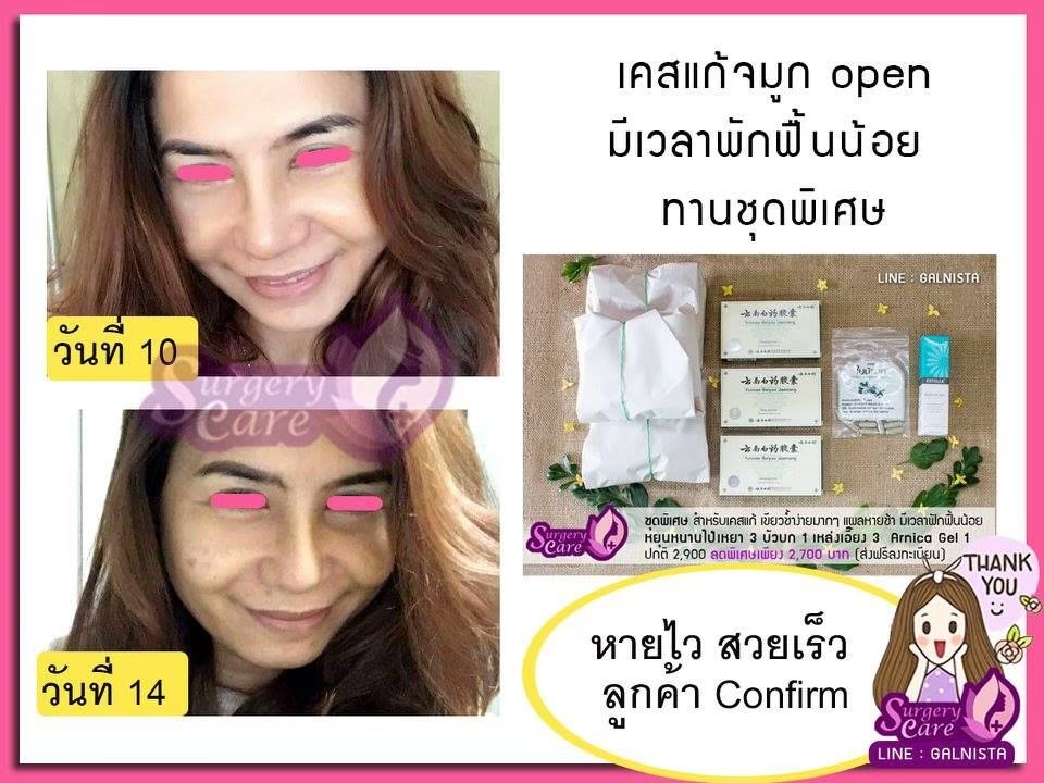 รีวิวแก้จมูก ลูกค้าทานสมุนไพรหยุนหนานไป๋เหยากับเหล่งเอี๊ยงExtra