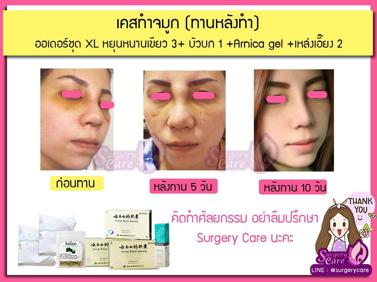 รีวิวจมูกทานหลังทำ,รีวิวจมูก,เหล่งเอี้ยง,เหล่งเอี้ยงextra ,สมุนไพรจีน,ยาลดบวมช้ำศัลยกรรม, ลดปวด, ลดอักเสบ, สมานแผล, ทำศัยกรรมอยากหายไว, เหล่งเอี้ยงของแท้, เหล่งเอี้ยง, เหล่งเอี้ยงextra, แผลหายไว, พักฟื้นน้อย, เขียวช้ำ, ลดบวมซ้ำ,ฟื้นตัวไว, หายไว, ยาลดบวม, หยุนหนานไป๋เหยา, หยุนหนานไป๋เหยากล่องเขียว, Yunnanpaiyao,สมุนไพรจีน, ยาลดบวมช้ำศัลยกรรม, ทำศัยกรรมอยากหายไว, หยุนหนานไป๋หยาของแท้, Surgerycare,
