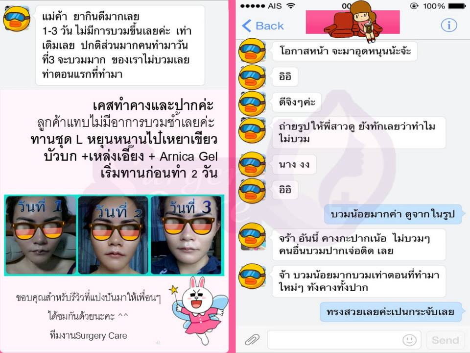 ทำปาก,รีวิวตัดปาก,รีวิวทำปาก,รีวิวทำปากกระจับ, รีวิวหยุนหนานไป๋เหยา,รีวิวเหล่งเอี๊ยง,รีวิวสมุนไพร,รีวิวลดบวมช้ำ,รีวิวศัลยกรรม, รีวิวจมูก, รีวิวตา, รีวิวคาง , รีวิวเสริมหน้าอก, รีวิวดูดไขมัน, รีวิวศัลยกรรม, ฟิลเลอร์, ร้อยไหม, หยุนหนานไป๋เหยา ,Yunnanpaiyao, เหล่งเอี้ยงextra ,surgerycare, review, รีวิวผ่าตัด 