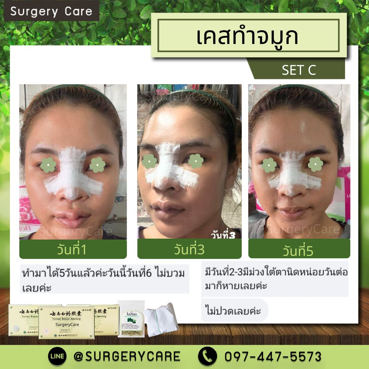 #หยุนหนานไป๋เหยา #Yunnanpaiyao #สมุนไพรจีน #ยาลดบวมช้ำศัลยกรรม #ลดปวด #ลดอักเสบ #สมานแผล #ศัลยกรรม #หายไว #แผลหายไว #พักฟื้น #เขียวช้ำ #ลดบวมซ้ำ #ฟื้นตัว #หายไว #ยาลดบวม #Surgerycare #จมูก #ตา #คาง #ปาก #หน้าอก #ดูดไขมัน