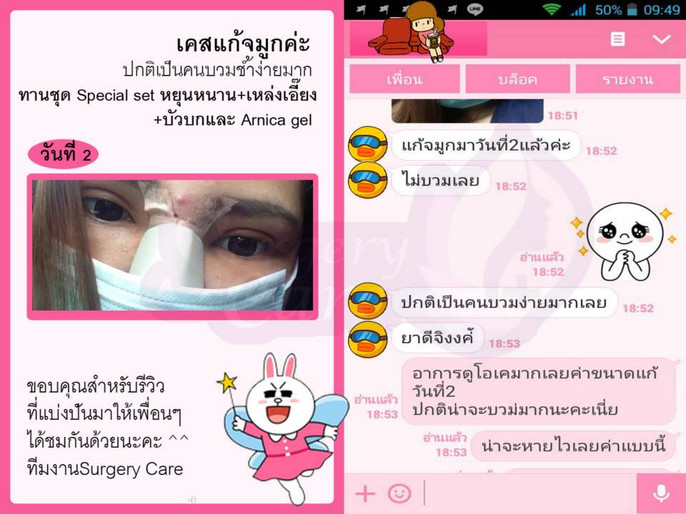 รีวิวแก้จมูก,รีวิวเสริมจมูก, รีวิวแก้จมูกOpen,บวมช้ำน้อย,หายไว, รีวิวแก้จมูกกระดูกอ่อนหลังหู,เหล่งเอี้ยง,เหล่งเอี้ยงextra ,สมุนไพรจีน,ยาลดบวมช้ำศัลยกรรม, ลดปวด, ลดอักเสบ, สมานแผล, ทำศัยกรรมอยากหายไว, เหล่งเอี้ยงของแท้, เหล่งเอี้ยง, เหล่งเอี้ยงextra, แผลหายไว, พักฟื้นน้อย, เขียวช้ำ, ลดบวมซ้ำ,ฟื้นตัวไว, หายไว, ยาลดบวม, หยุนหนานไป๋เหยา, หยุนหนานไป๋เหยากล่องเขียว, Yunnanpaiyao,สมุนไพรจีน, ยาลดบวมช้ำศัลยกรรม, ทำศัยกรรมอยากหายไว, หยุนหนานไป๋หยาของแท้, Surgerycare,