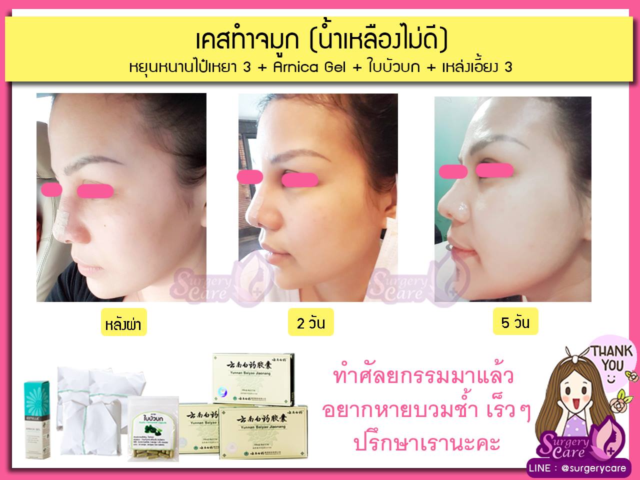 งัดดั้ง,เสริมจมูก,รีวิวทำจมูก,รีวิวแก้จมูก,แก้จมูกOpen,รีวิวหยุนหนานไป๋เหยา รีวิวเหล่งเอี้ยง รีวิวสมุนไพร รีวิวบัวบก รีวิวลดบวมช้ำ รีวิวศัลยกรรม รีวิวจมูก รีวิวตา รีวิวคาง รีวิวปาก รีวิวเสริมหน้าอก รีวิวดูดไขมัน รีวิว ศัลยกรรม ฟิลเลอร์ ร้อยไหม หยุนหนานไป๋เหยา Yunnanpaiyao เหล่งเอี้ยง เหล่งเอี้ยงextra surgerycare