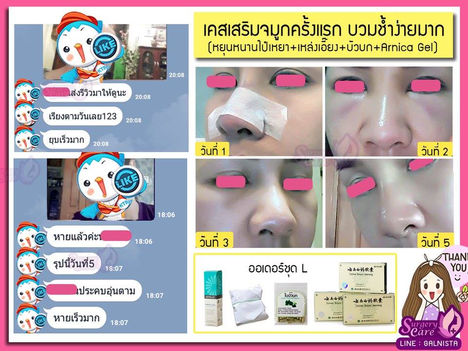งัดดั้ง,เสริมจมูก,รีวิวทำจมูก,รีวิวแก้จมูก,แก้จมูกOpen,รีวิวหยุนหนานไป๋เหยา รีวิวเหล่งเอี้ยง รีวิวสมุนไพร รีวิวบัวบก รีวิวลดบวมช้ำ รีวิวศัลยกรรม รีวิวจมูก รีวิวตา รีวิวคาง รีวิวปาก รีวิวเสริมหน้าอก รีวิวดูดไขมัน รีวิว ศัลยกรรม ฟิลเลอร์ ร้อยไหม หยุนหนานไป๋เหยา Yunnanpaiyao เหล่งเอี้ยง เหล่งเอี้ยงextra surgerycare