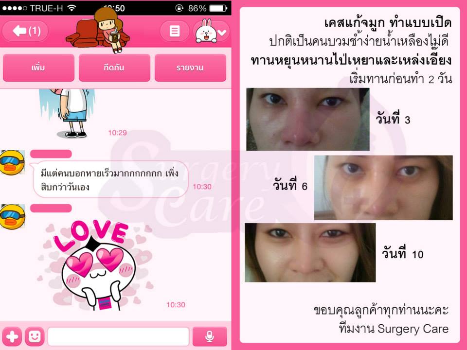 รีวิวแก้จมูก,เหล่งเอี้ยง, เหล่งเอี้ยงextra, สมุนไพรจีน, ยาลดบวมช้ำศัลยกรรม, ลดปวด, ลดอักเสบ, สมานแผล, ทำศัยกรรมอยากหายไว, เหล่งเอี้ยงของแท้, เหล่งเอี้ยง, เหล่งเอี้ยงextra, แผลหายไว, พักฟื้น, เขียวช้ำ, ลดบวมซ้ำ, ฟื้นตัว, หายไว, ยาลดบวม, รีวิวดูดไขมัน,รีวิวทำหน้าวีเชฟ,รีวิวทุบหน้า, หยุนหนานไป๋เหยา, หยุนหนานไป๋เหยากล่องเขียว, Yunnanpaiyao, สมุนไพรจีน, ยาลดบวมช้ำศัลยกรรม, ทำศัยกรรมอยากหายไว, หยุนหนานไป๋หยาของแท้, Surgerycare,