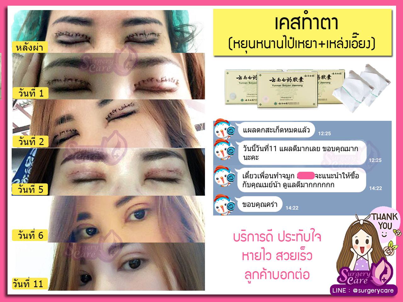 รีวิวทำตา,แก้ตา,ทำตา,ตา2ชั้น,รีวิวศัลยกรรมตา2ชั้น,รีวิวผ่าตา,รีวิวทำตา,รีวิวทำตาสองชั้น,รีวิวลดบวมช้ำ รีวิวศัลยกรรม,รีวิว, ศัลยกรรม, หยุนหนานไป๋เหยา, Yunnanpaiyao, เหล่งเอี้ยง, เหล่งเอี้ยงextra, surgerycare, review, รีวิวผ่าตัด