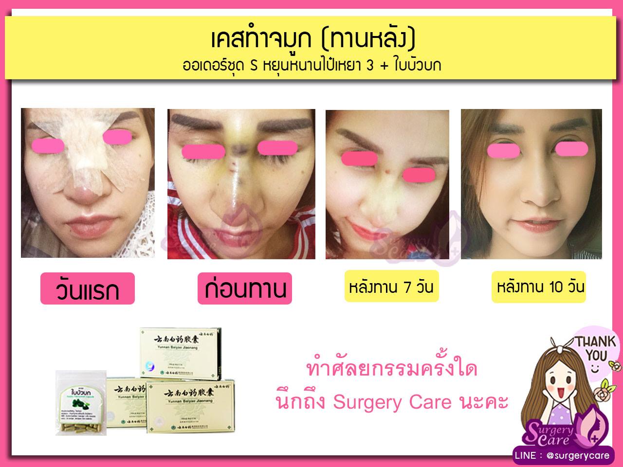 รีวิวจมูกทานหลังทำ,รีวิวจมูก,เหล่งเอี้ยง,เหล่งเอี้ยงextra ,สมุนไพรจีน,ยาลดบวมช้ำศัลยกรรม, ลดปวด, ลดอักเสบ, สมานแผล, ทำศัยกรรมอยากหายไว, เหล่งเอี้ยงของแท้, เหล่งเอี้ยง, เหล่งเอี้ยงextra, แผลหายไว, พักฟื้นน้อย, เขียวช้ำ, ลดบวมซ้ำ,ฟื้นตัวไว, หายไว, ยาลดบวม, หยุนหนานไป๋เหยา, หยุนหนานไป๋เหยากล่องเขียว, Yunnanpaiyao,สมุนไพรจีน, ยาลดบวมช้ำศัลยกรรม, ทำศัยกรรมอยากหายไว, หยุนหนานไป๋หยาของแท้, Surgerycare,