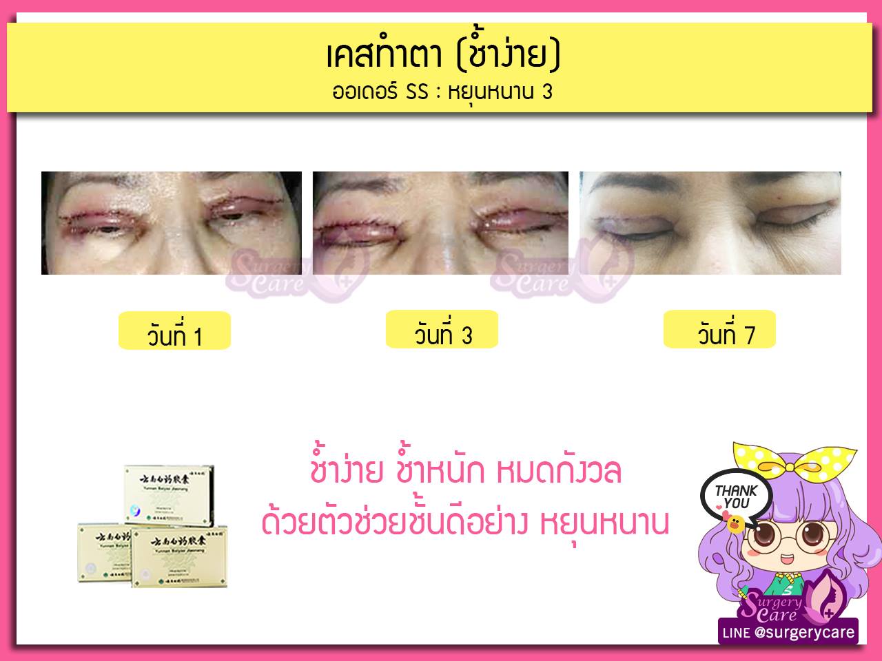 รีวิวทำตา,แก้ตา,ทำตา,ตา2ชั้น,รีวิวศัลยกรรมตา2ชั้น,รีวิวผ่าตา,รีวิวทำตา,รีวิวทำตาสองชั้น,รีวิวลดบวมช้ำ รีวิวศัลยกรรม,รีวิว, ศัลยกรรม, หยุนหนานไป๋เหยา, Yunnanpaiyao, เหล่งเอี้ยง, เหล่งเอี้ยงextra, surgerycare, review, รีวิวผ่าตัด